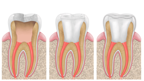 Last three steps of Root Canal