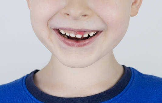 A child smiling with an irritated tooth