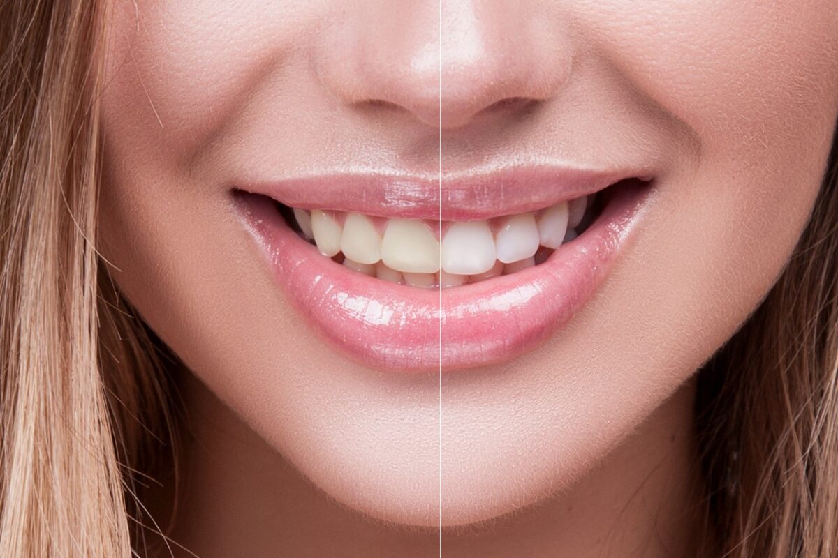 before and after of teeth cleaning