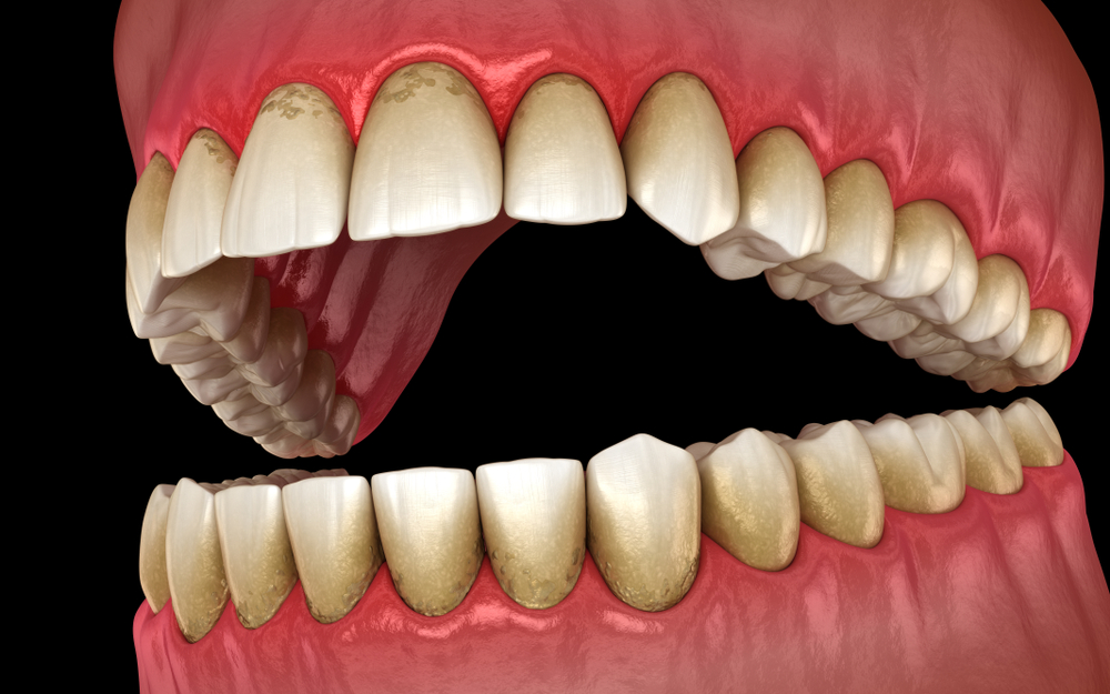 An example of teeth in need of Periodontal Scaling and Planing