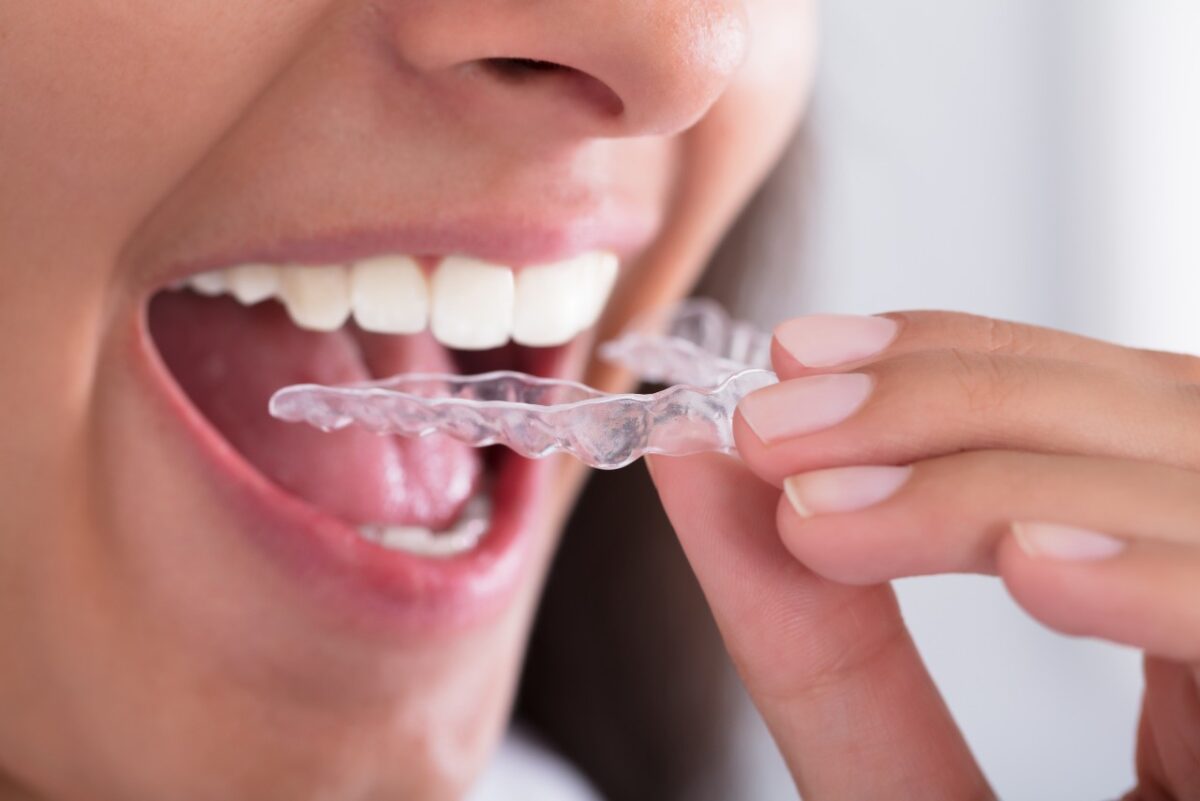 Close-up Of Woman's Hand Putting Transparent Aligner In Teeth