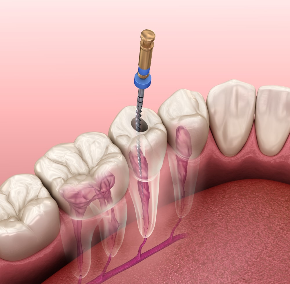dental root canal treatment