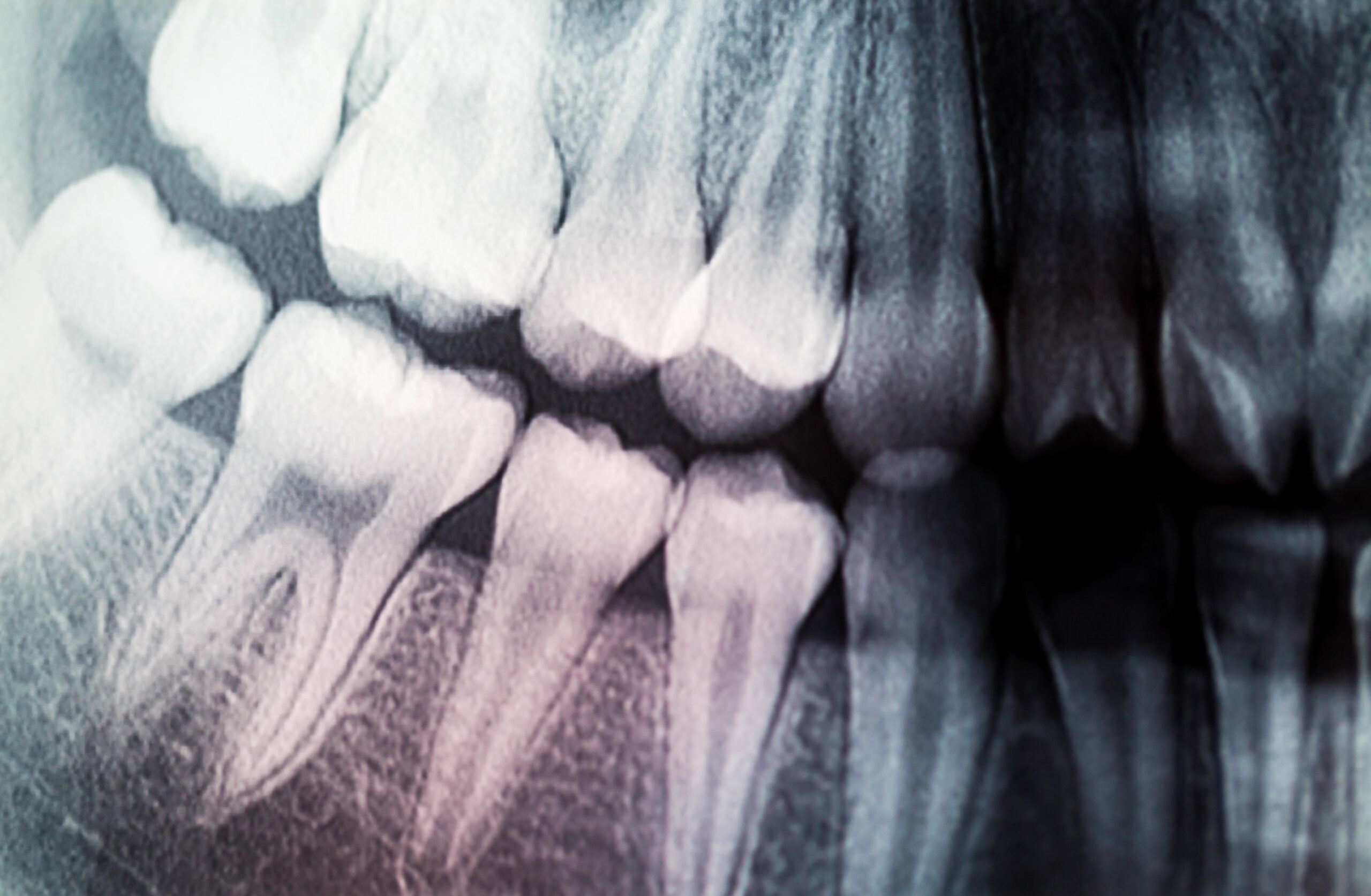 dental x-ray