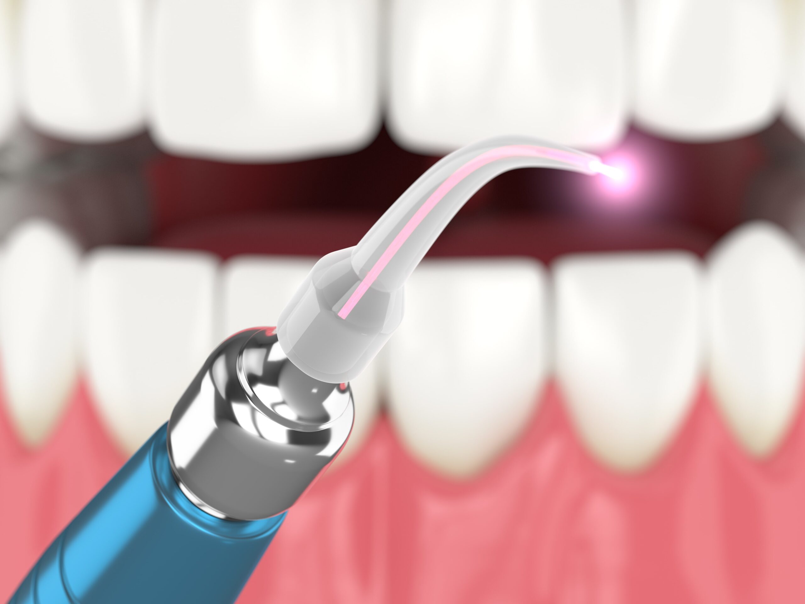 dental laser being used for treatment