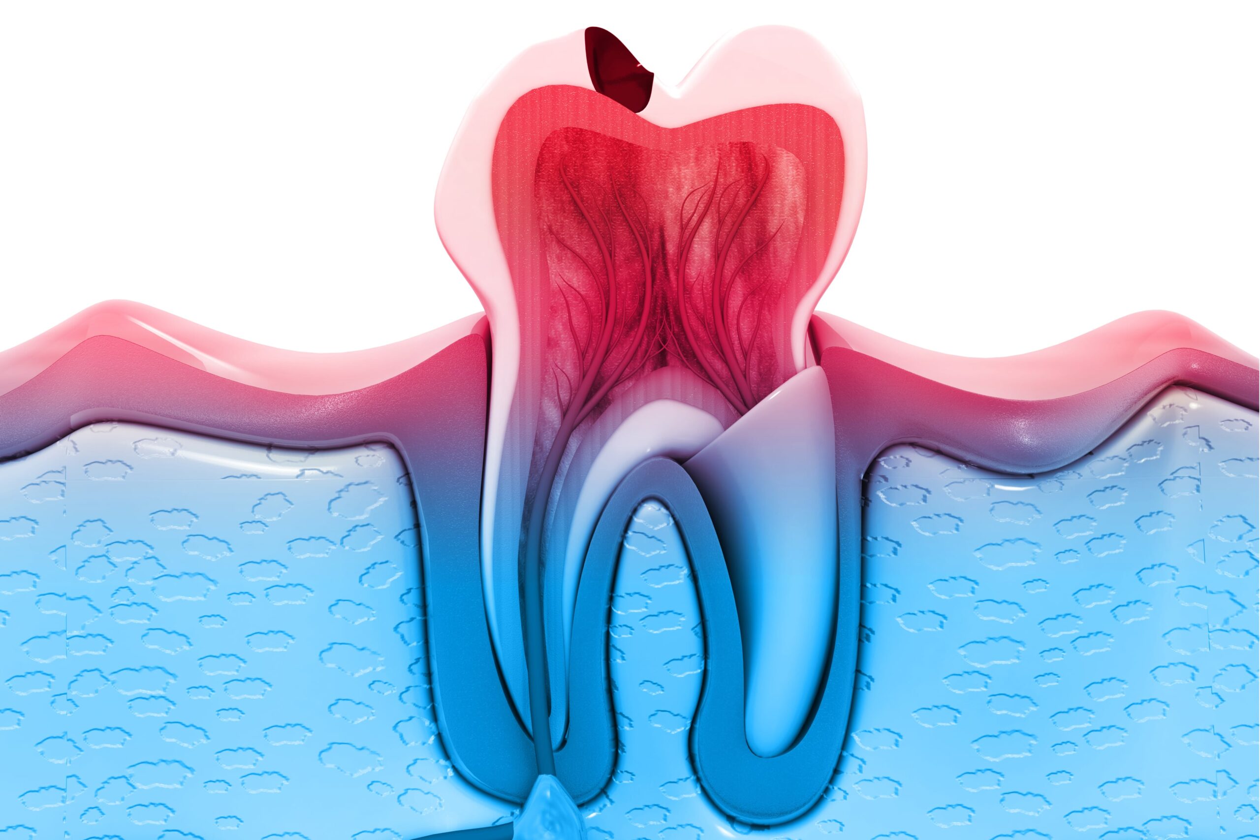 severely decayed tooth with pulpitis