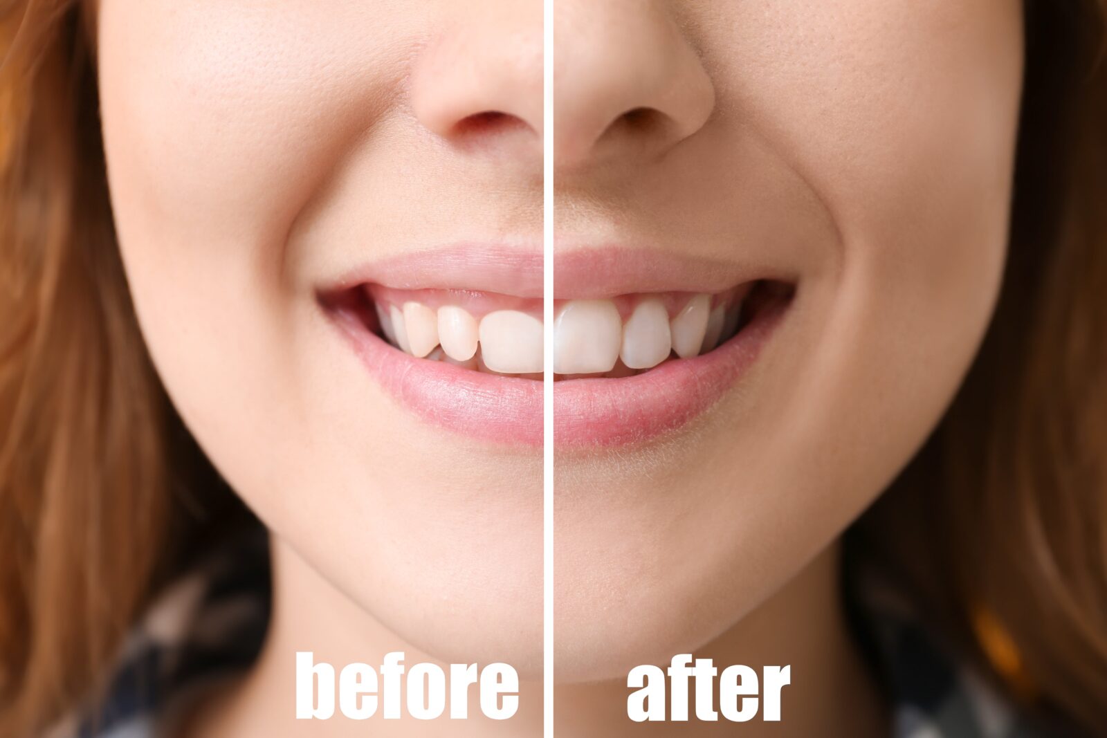 before and after gum controuring