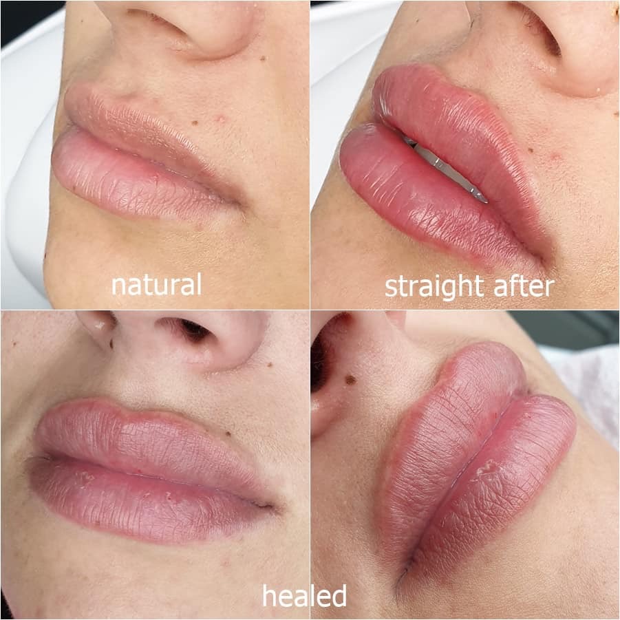 Photo 12 07 2019 19 22 34 showing the concept of Lip Enhancement Gallery
