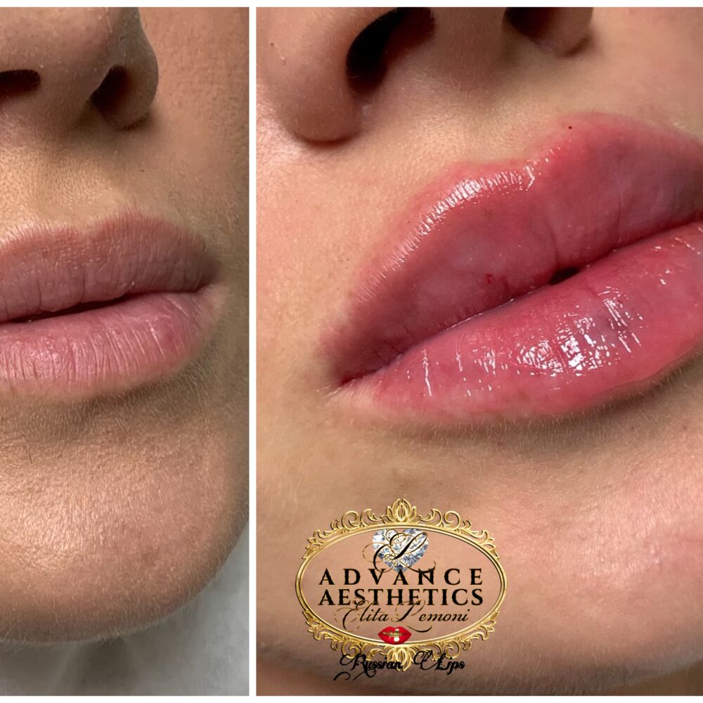Photo 12 10 2019 20 34 00 showing the concept of Lip Enhancement Gallery