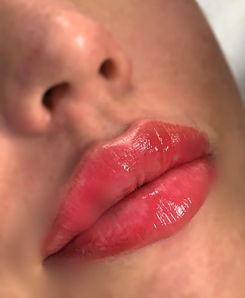Photo 14 09 2019 03 36 57 showing the concept of Lip Enhancement Gallery