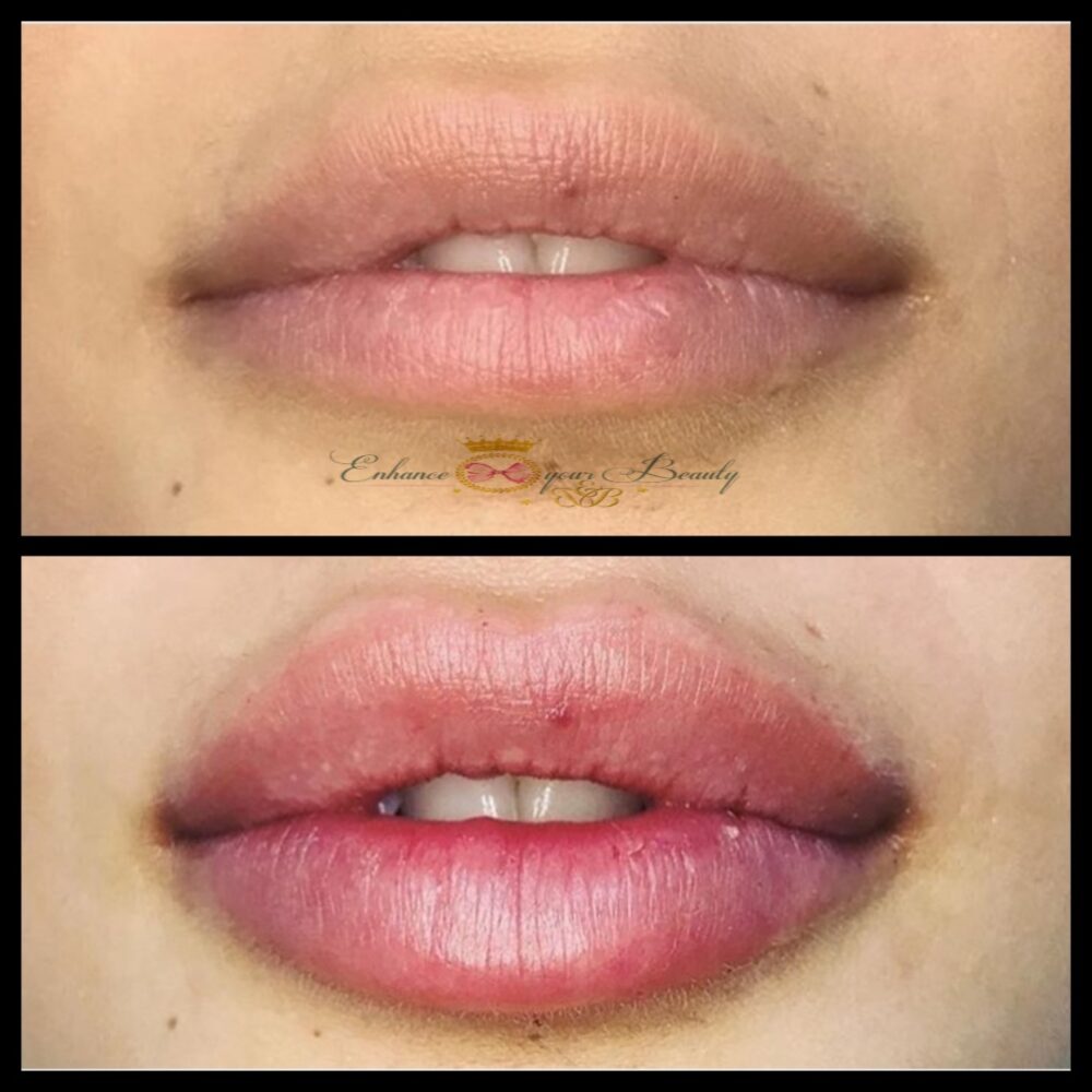Photo 17 06 2019 22 40 18 showing the concept of Lip Enhancement Gallery