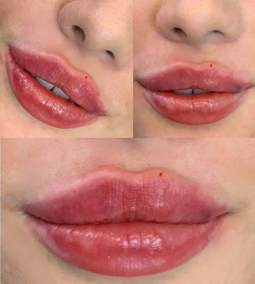 Photo 22 10 2019 12 48 38 showing the concept of Lip Enhancement Gallery