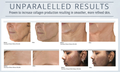 unnamed 4 showing the concept of Genius TM Fractional Radiofrequency (RF) Microneedling & Morpheus 8 Skin tightening