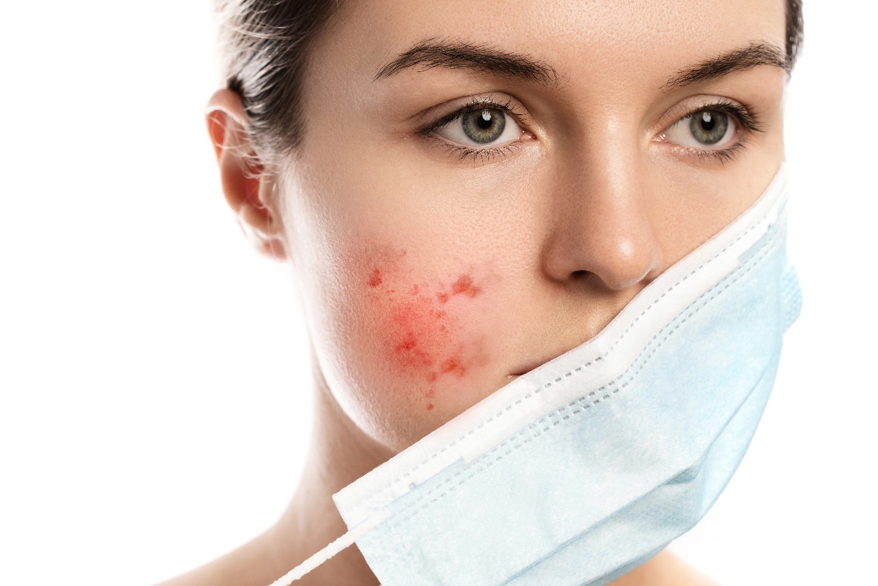 shutterstock 1964048851 1 showing the concept of Acne Treatment, Mask Acne, Teenage Acne