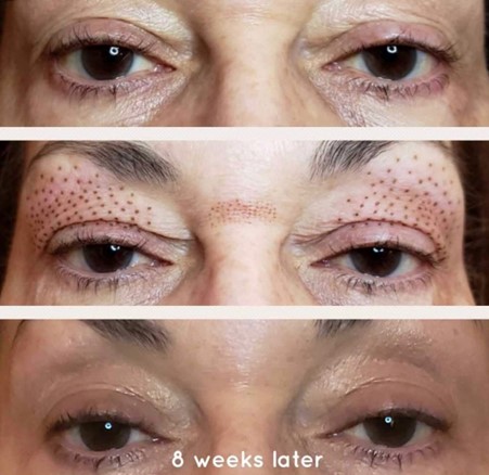 Non Surgical Plasma Fibroblst Lifting 1 showing the concept of Non Surgical Plasma Fibroblst Lifting – Plexr Plasma for Blepharoptosis and skin lifting