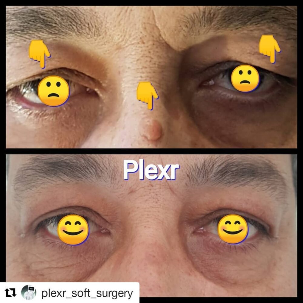 59002776 551676572028106 9103737365568841652 n showing the concept of Plexr Treatments
