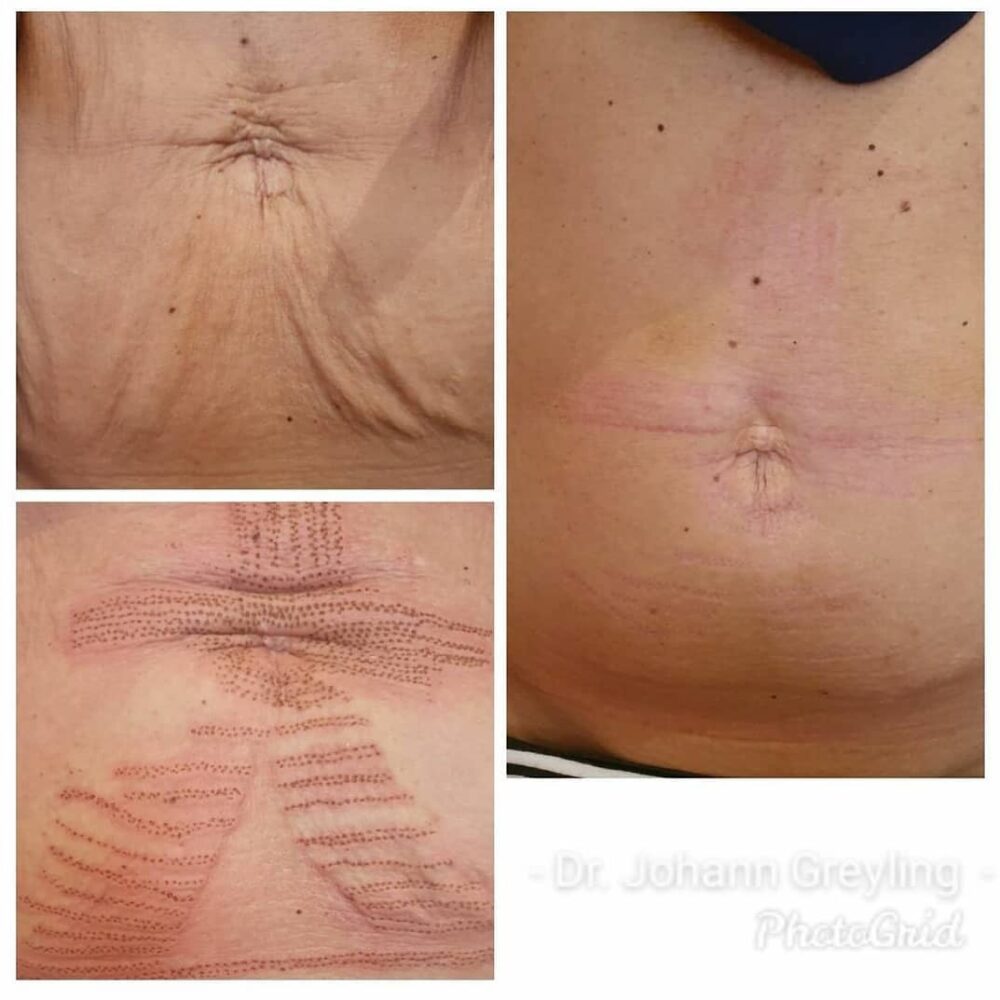 Excess of Skin Belly after 2 pregnancies showing the concept of Plexr Treatments