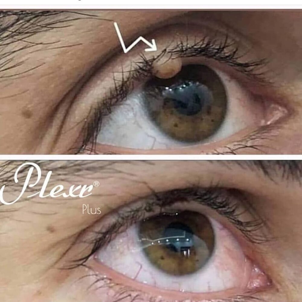 Eye showing the concept of Plexr Treatments