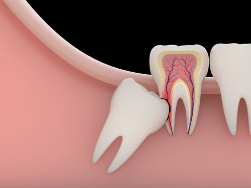 wisdom teeth removal in Beaverlodge, CA | impacted wisdom tooth causing complications