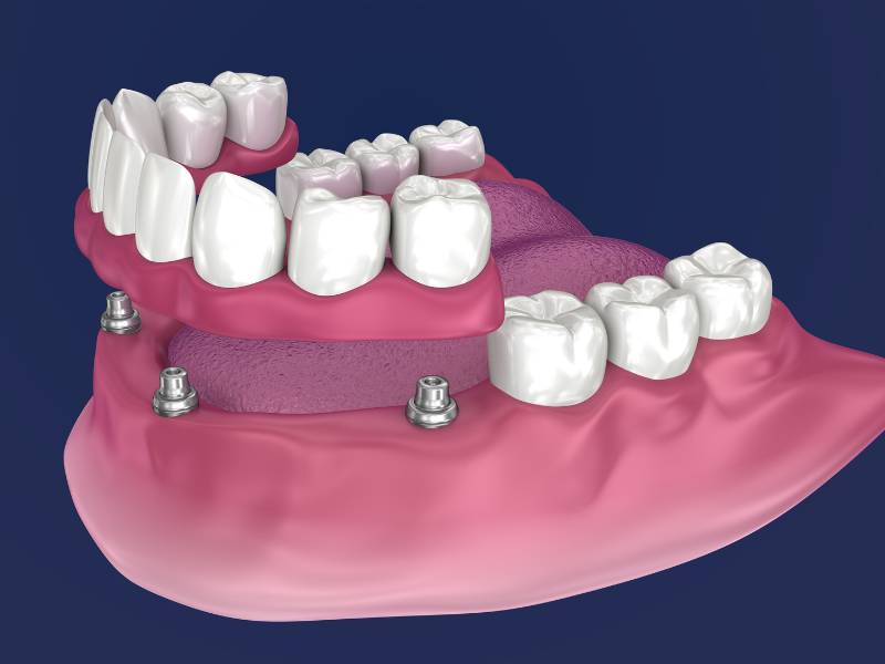 Illustration of an implant-supported denture, also called all-on-four implants