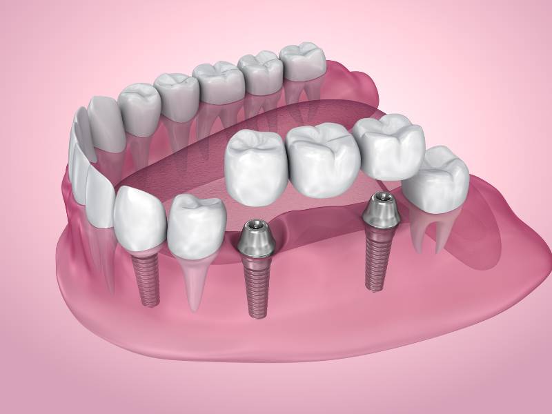 Illustration of an implant-supported bridge