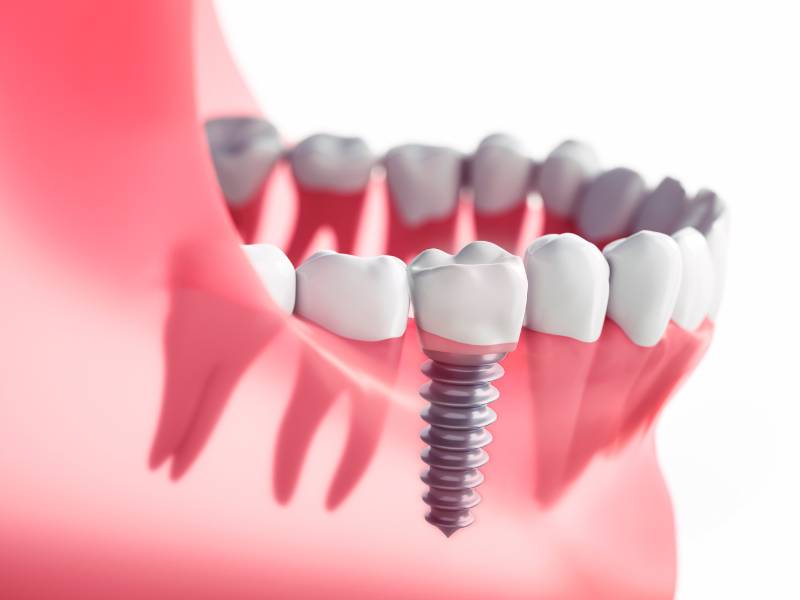 Illustration of a single dental implant