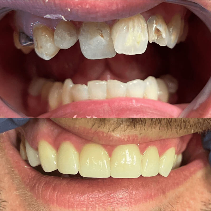 Before and after treatment