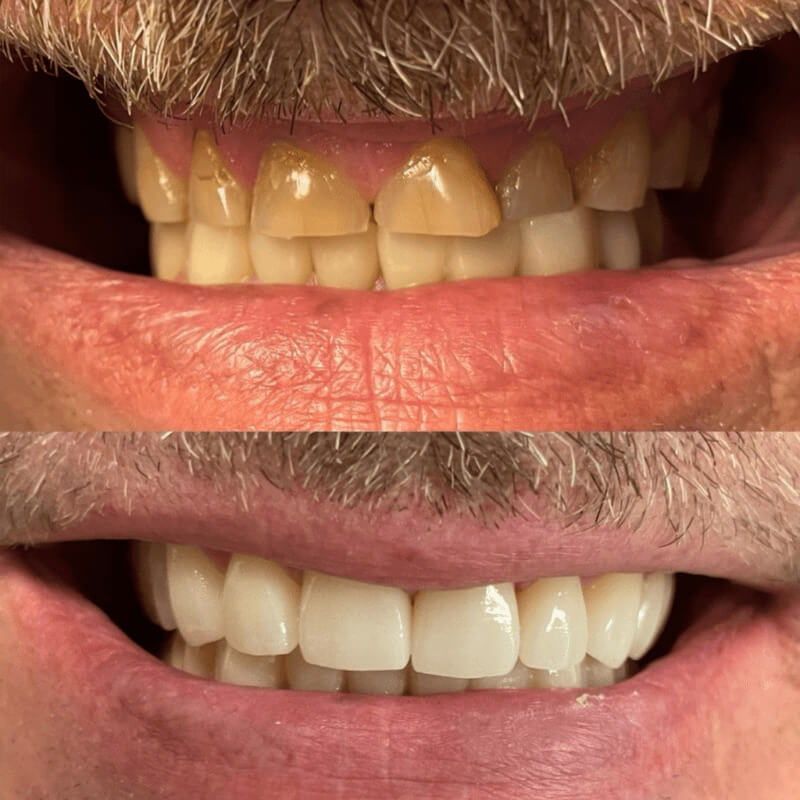 Before and after treatment