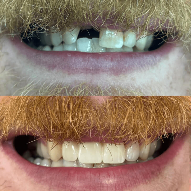 Before and after treatment