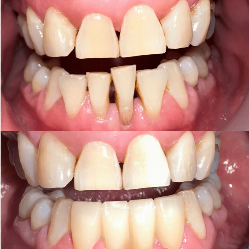 Before and after treatment