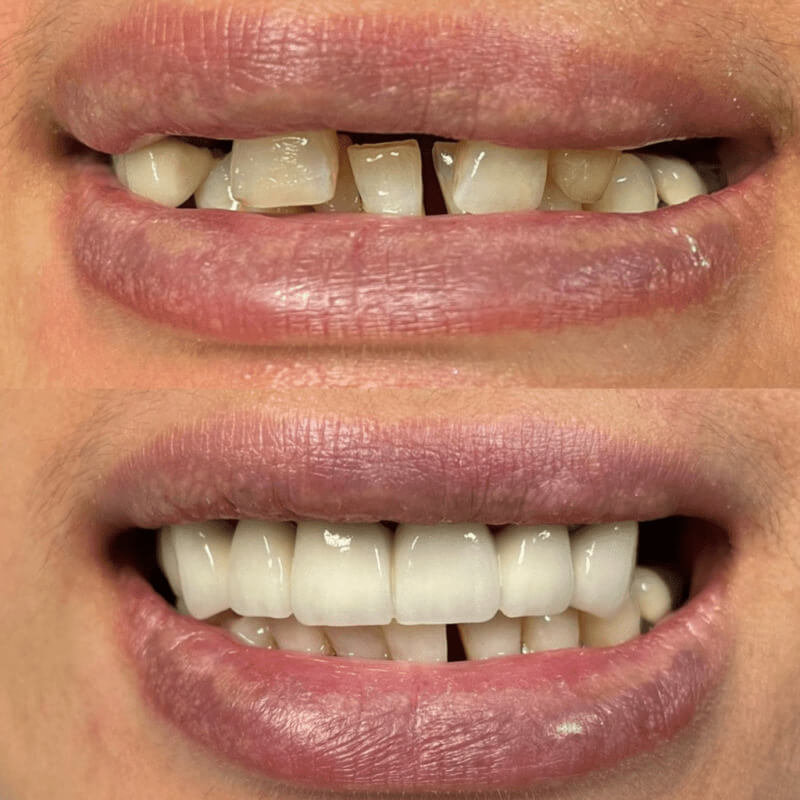 Before and after treatment