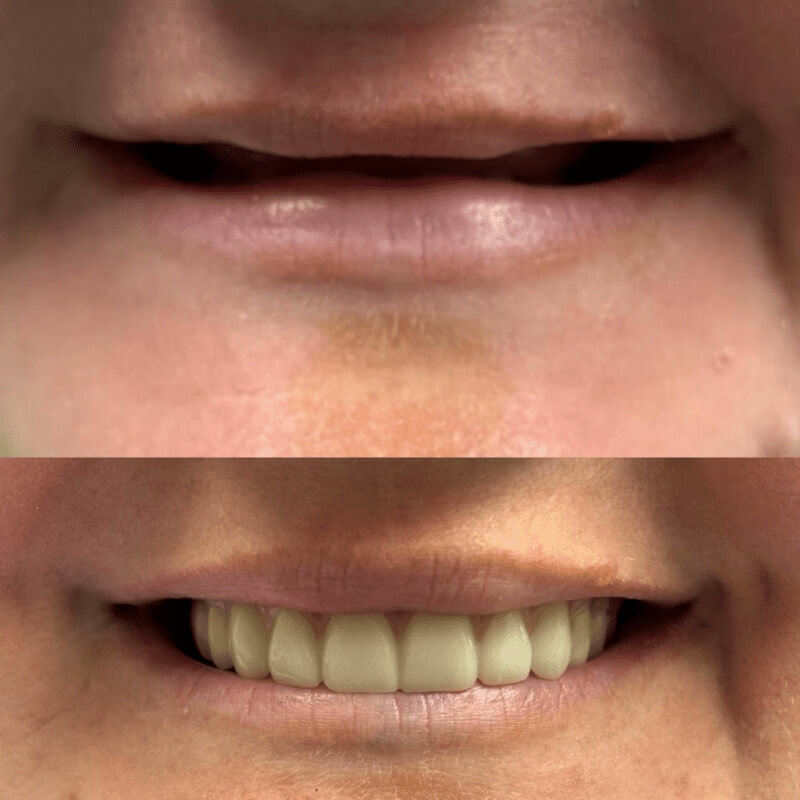 All-On-X before and after treatment