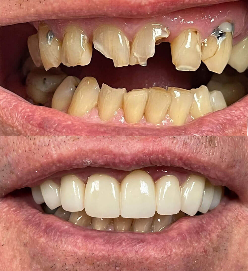 Before and after treatment