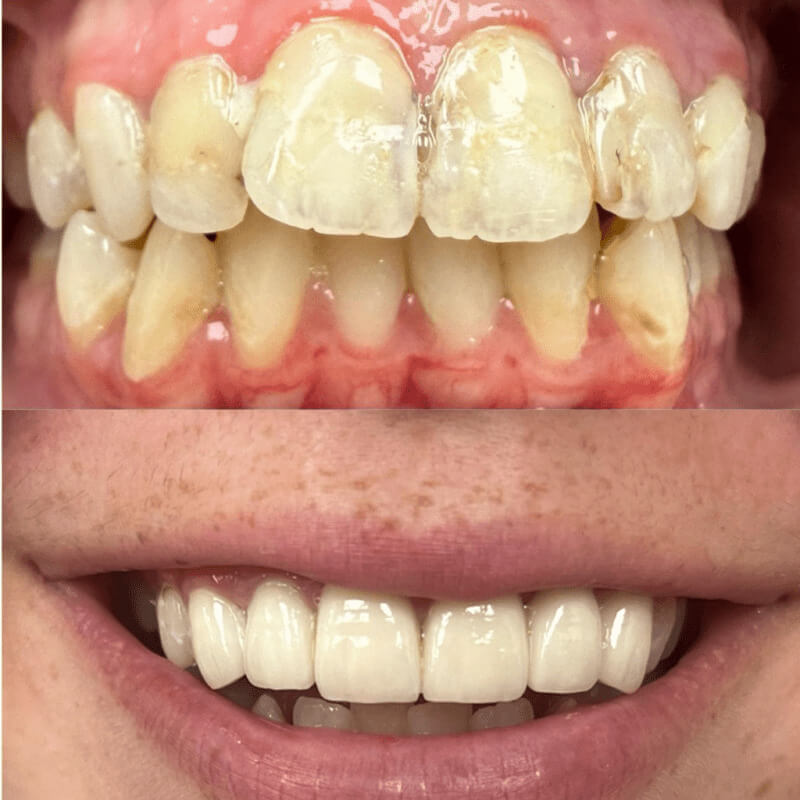 Anterior Crowns before and after treatment