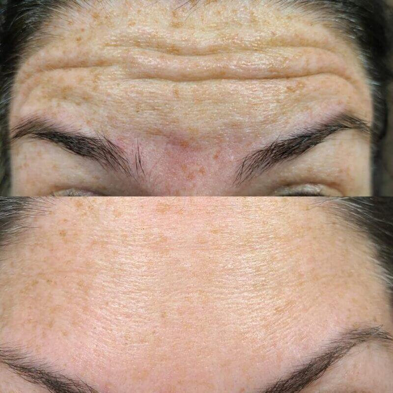 BOTOX before and after treatment