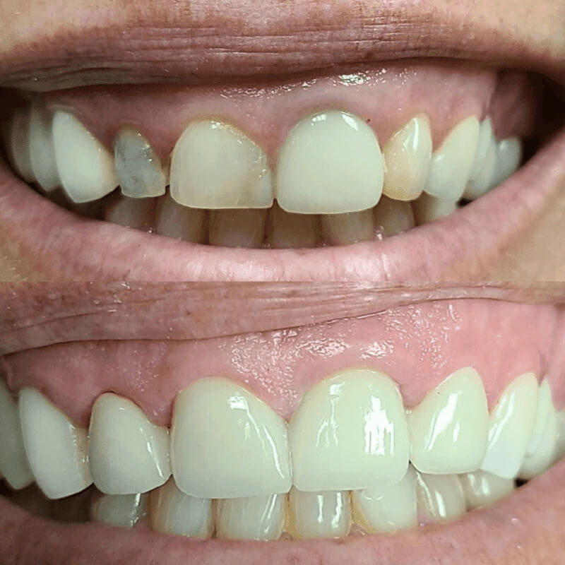 Porcelain Crowns before and after treatment