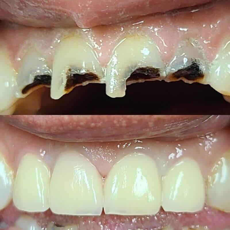 Porcelain Crowns before and after treatment