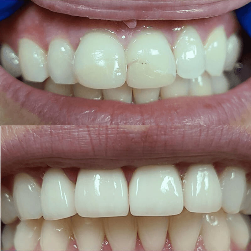 Porcelain Crowns before and after treatment