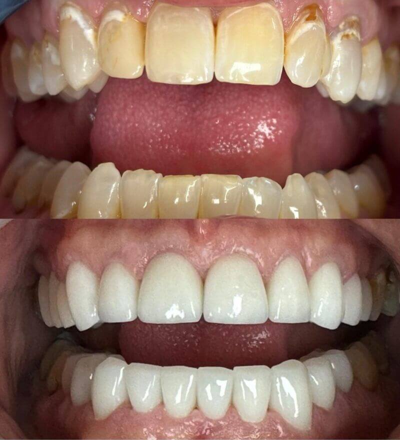 upper-and-lower-crowns Before and after treatment