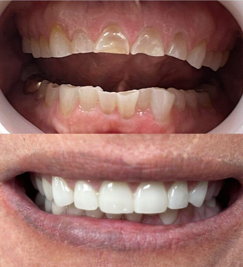 upper-and-lower-crowns before and after treatment