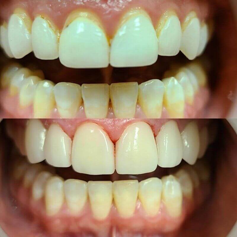 Veneers Before and after treatment