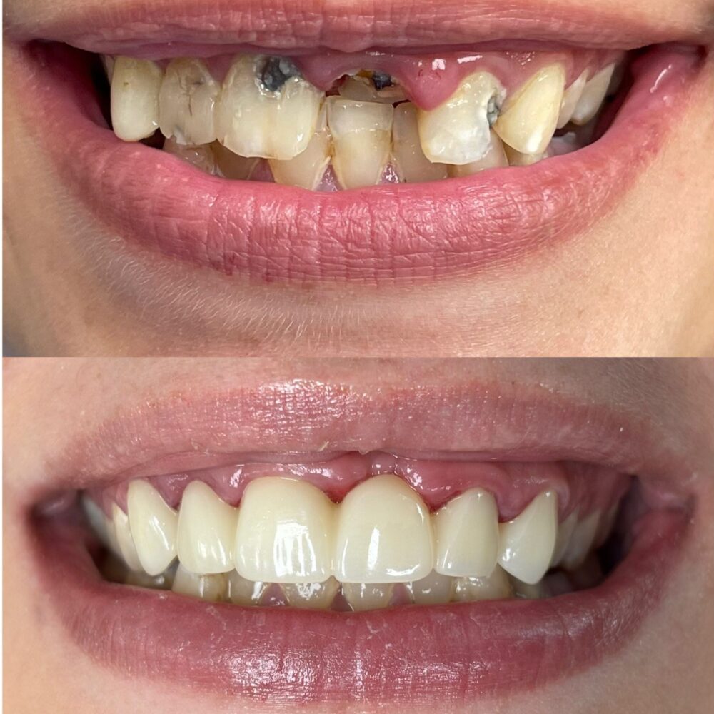 Before and After Anterior Bridge