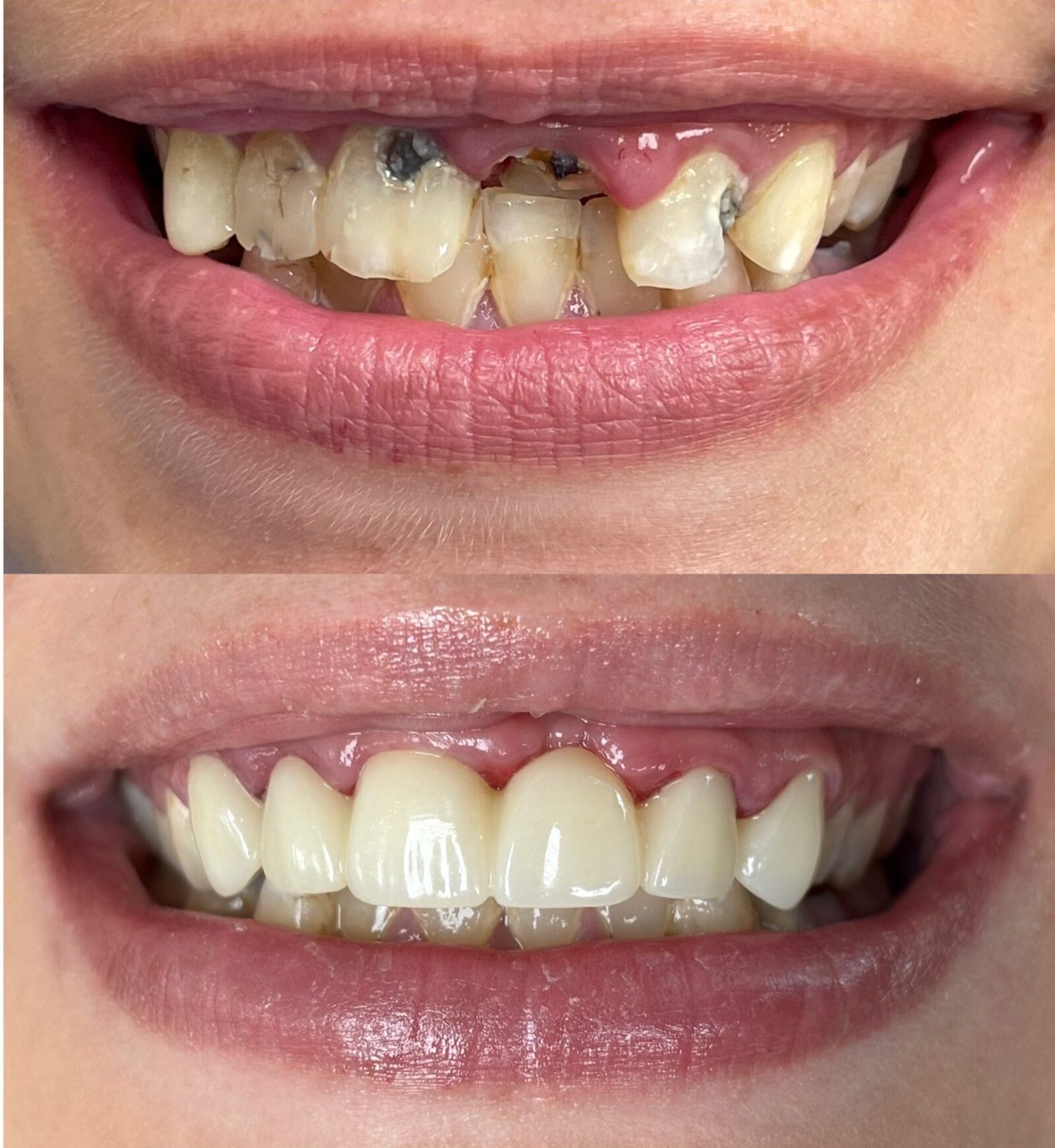 Before and After Anterior Bridge