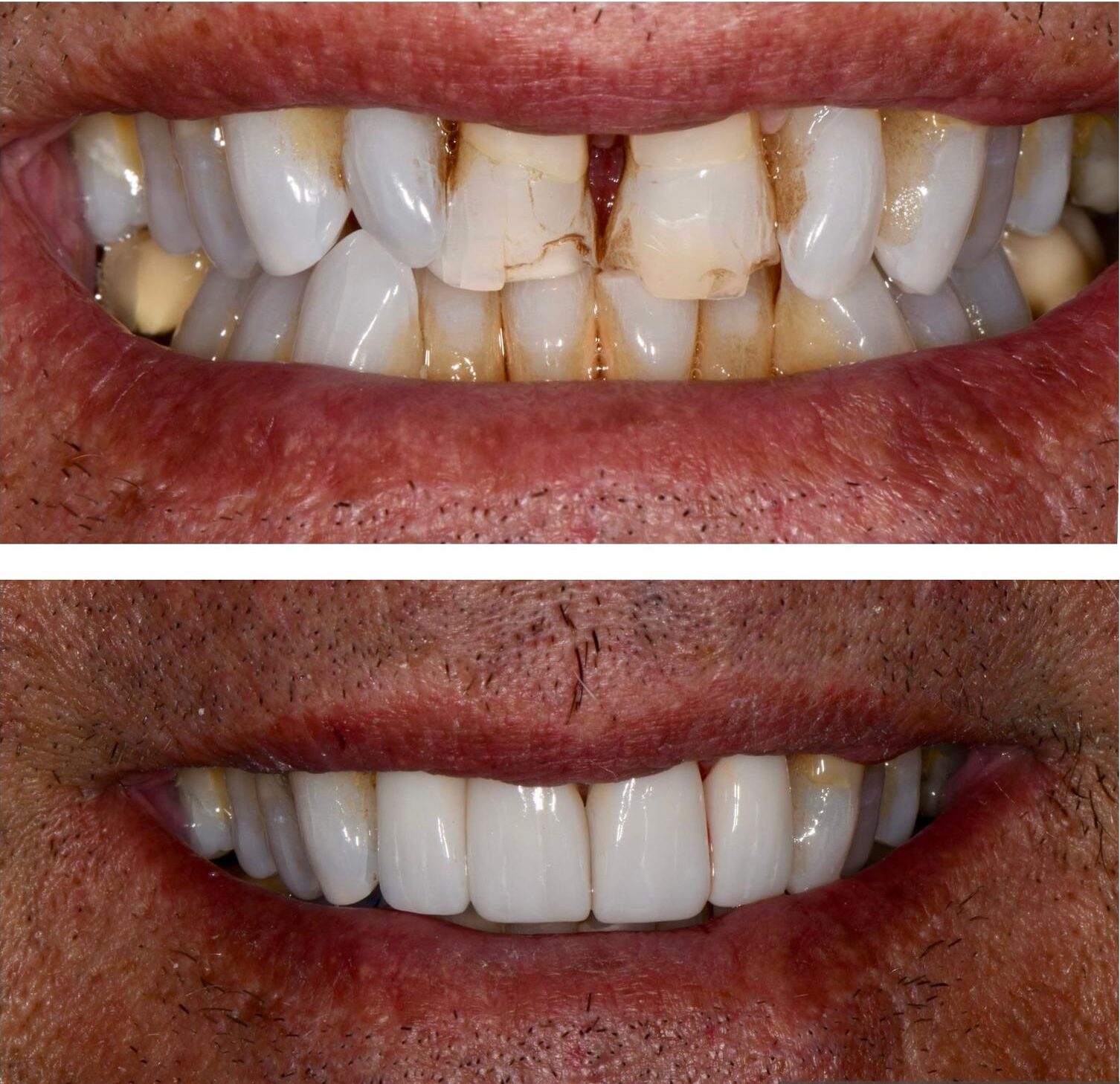 Before and After Anterior Crowns