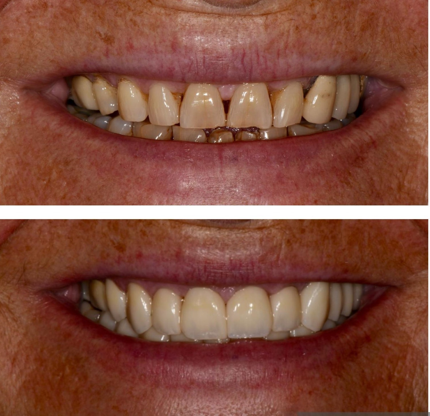 Before and After Anterior Crowns