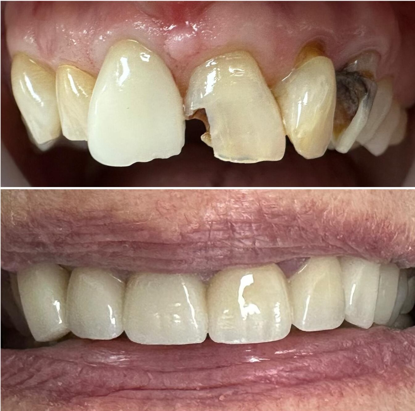 BEfore and After Anterior Crowns