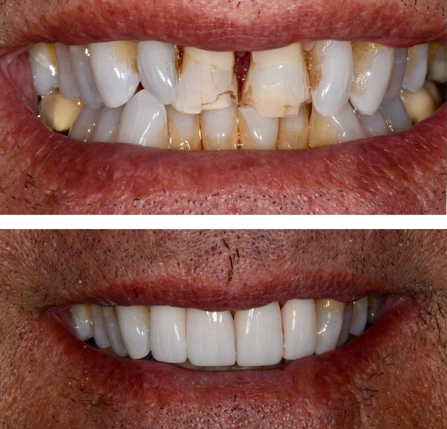 Before and After Dental Crowns