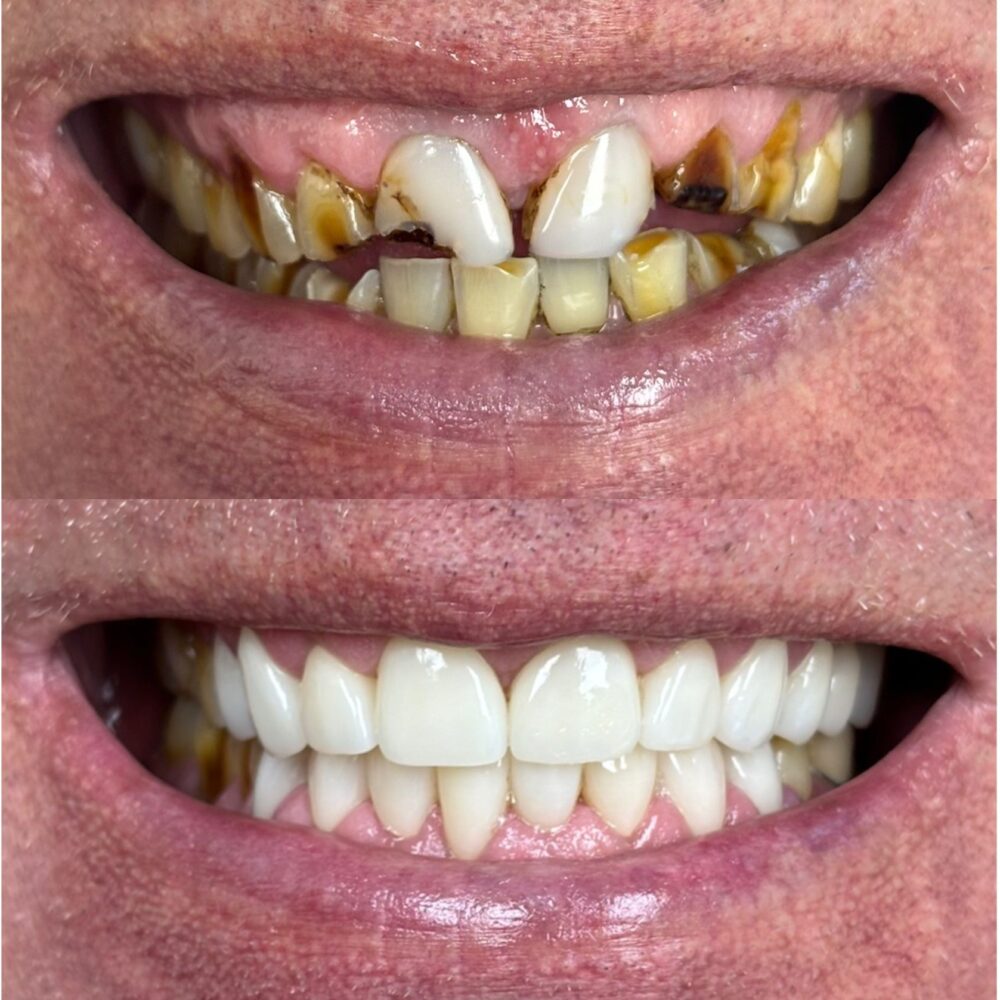Full arch restoration with porcelain crowns in Cape Coral, FL