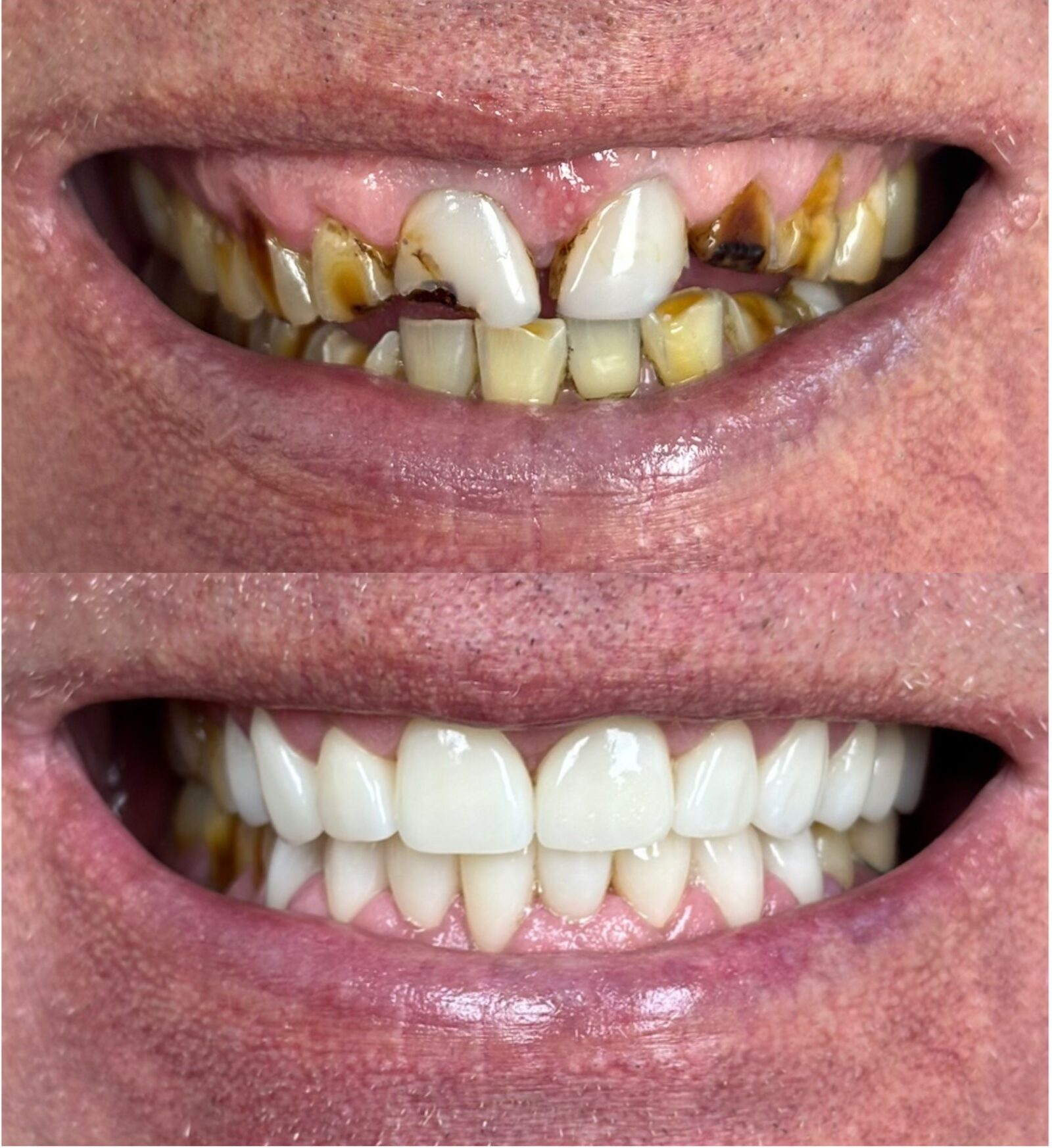 Full arch restoration with porcelain crowns in Cape Coral, FL