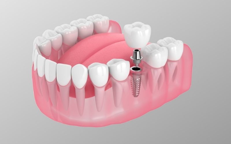 Dental implants at Sunset Habor Dental Cape Coral, FL