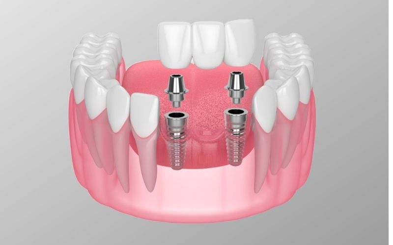 Implant supported dental bridge Cape Coral, FL
